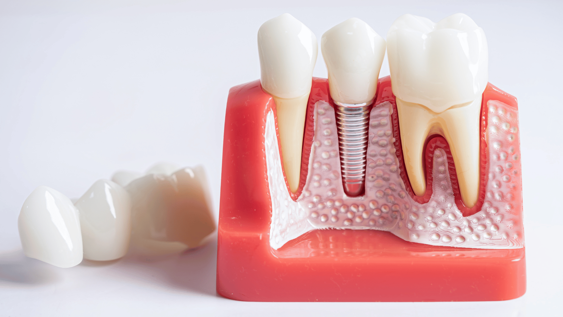 Czym jest stabilność implantów?
